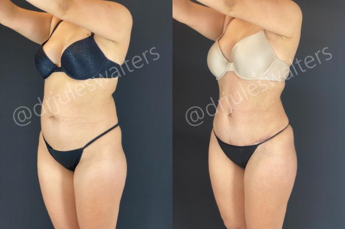 Before & After Tummy Tuck Case 165 Left Oblique View in Metairie and New Orleans, LA