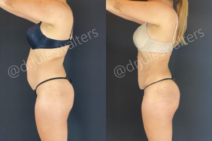 Before & After Tummy Tuck Case 165 Left Side View in Metairie and New Orleans, LA