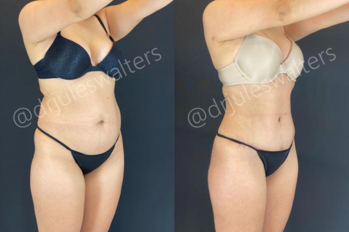 Before & After Tummy Tuck Case 165 Right Oblique View in Metairie and New Orleans, LA