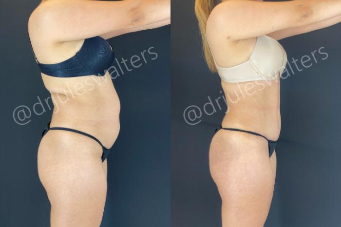 Before & After Tummy Tuck Case 165 Right Side View in Metairie and New Orleans, LA