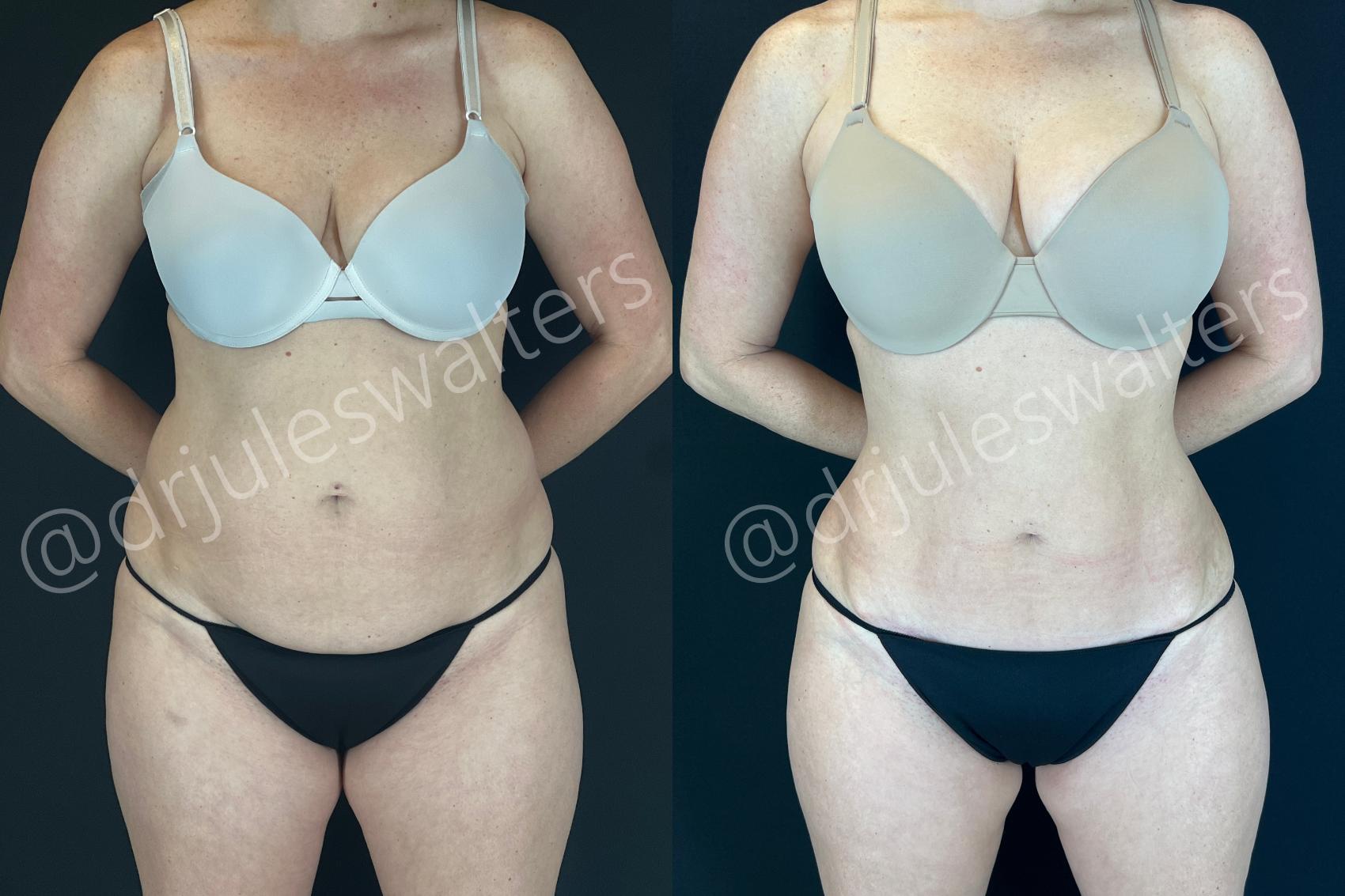 Before & After Tummy Tuck Case 172 Front View in Metairie and New Orleans, LA