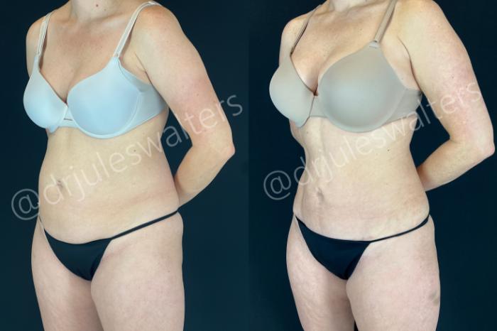 Before & After Tummy Tuck Case 172 Left Oblique View in Metairie and New Orleans, LA