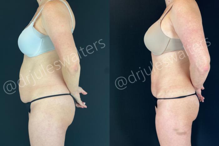 Before & After Tummy Tuck Case 172 Left Side View in Metairie and New Orleans, LA
