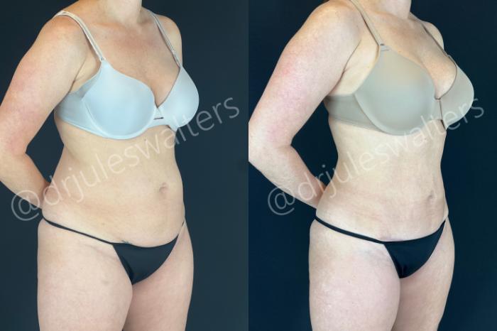 Before & After Tummy Tuck Case 172 Right Oblique View in Metairie and New Orleans, LA