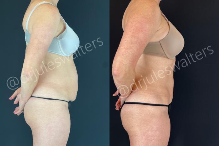 Before & After Tummy Tuck Case 172 Right Side View in Metairie and New Orleans, LA