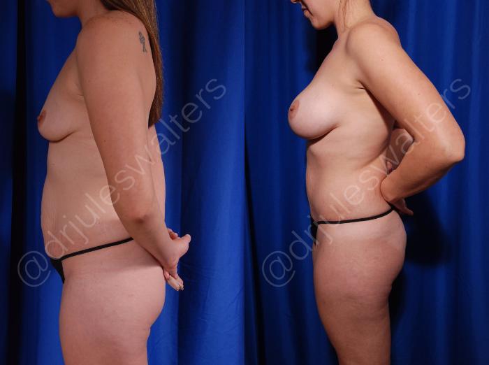 Before & After Tummy Tuck Case 18 View #3 View in Metairie and New Orleans, LA