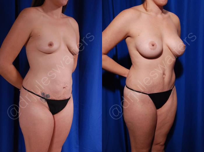 Before & After Tummy Tuck Case 18 View #4 View in Metairie and New Orleans, LA