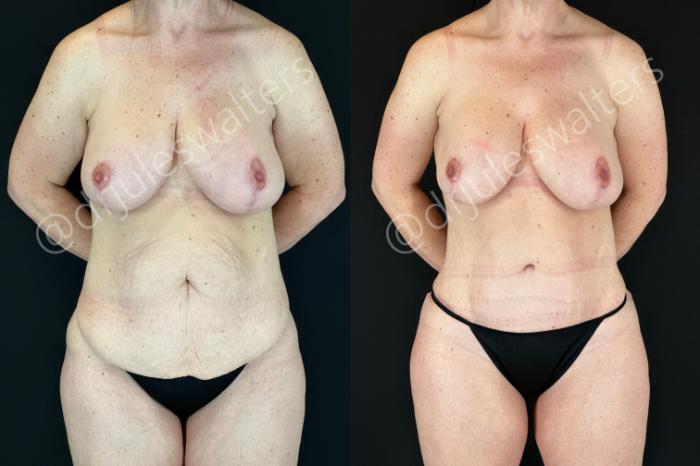 Before & After Tummy Tuck Case 180 Front View in Metairie and New Orleans, LA