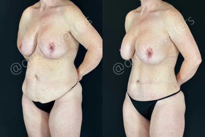Before & After Tummy Tuck Case 180 Left Oblique View in Metairie and New Orleans, LA