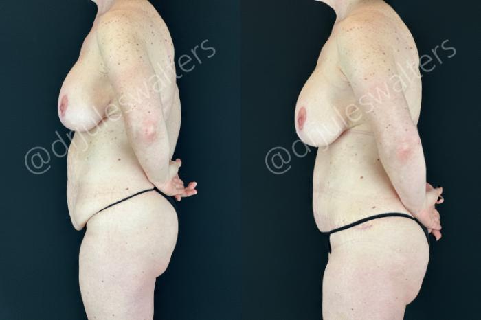 Before & After Tummy Tuck Case 180 Left Side View in Metairie and New Orleans, LA