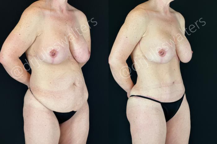Before & After Tummy Tuck Case 180 Right Oblique View in Metairie and New Orleans, LA
