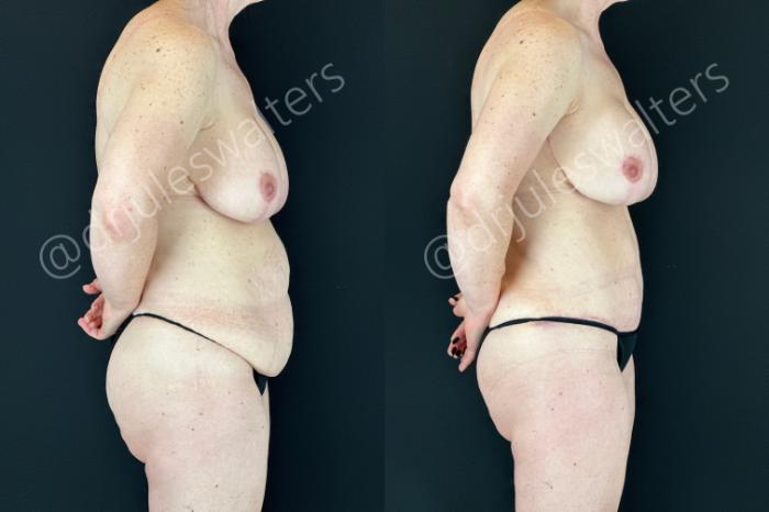 Before & After Tummy Tuck Case 180 Right Side View in Metairie and New Orleans, LA