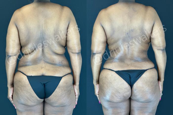 Before & After Tummy Tuck Case 181 Back View in Metairie and New Orleans, LA