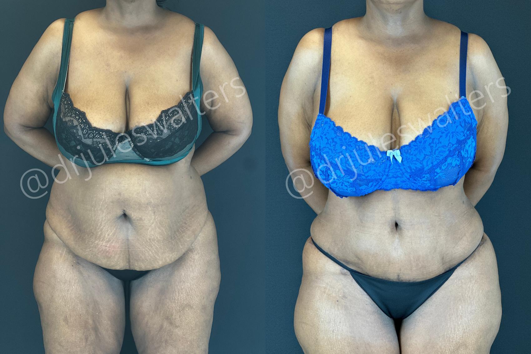 Before & After Tummy Tuck Case 181 Front View in Metairie and New Orleans, LA