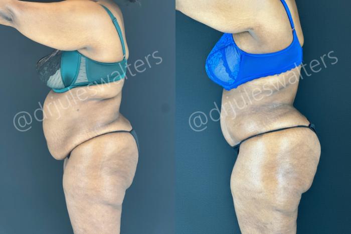 Before & After Tummy Tuck Case 181 Left Side View in Metairie and New Orleans, LA