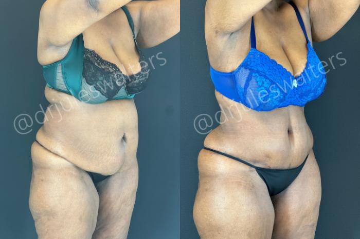 Before & After Tummy Tuck Case 181 Right Oblique View in Metairie and New Orleans, LA