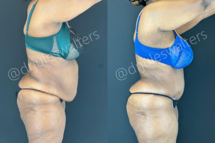 Before & After Tummy Tuck Case 181 Right Side View in Metairie and New Orleans, LA