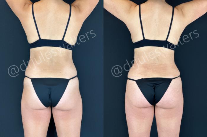 Before & After Tummy Tuck Case 183 Back View in Metairie and New Orleans, LA