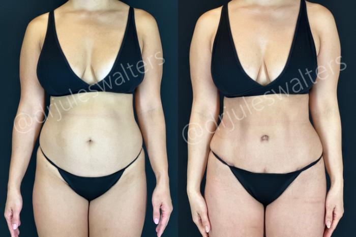 Before & After Tummy Tuck Case 183 Front View in Metairie and New Orleans, LA