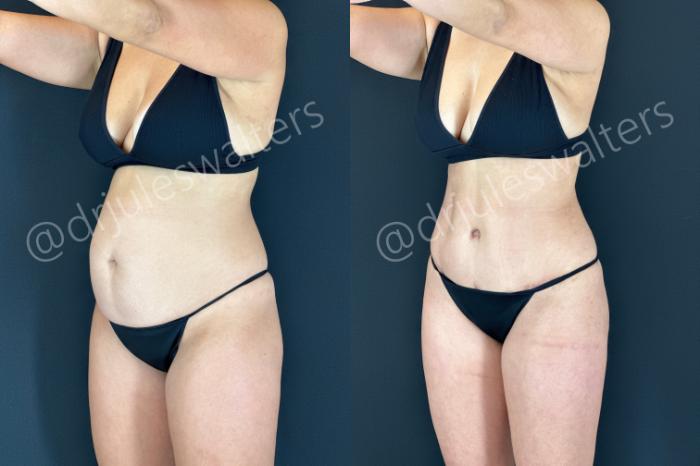Before & After Liposuction Case 183 Left Oblique View in Metairie and New Orleans, LA
