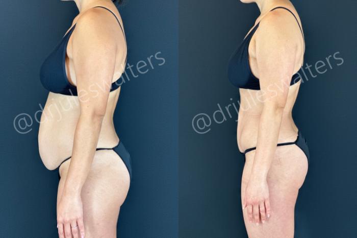 Before & After Tummy Tuck Case 183 Left Side View in Metairie and New Orleans, LA