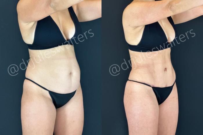 Before & After Tummy Tuck Case 183 Right Oblique View in Metairie and New Orleans, LA