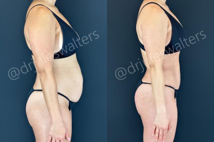 Before & After Tummy Tuck Case 183 Right Side View in Metairie and New Orleans, LA