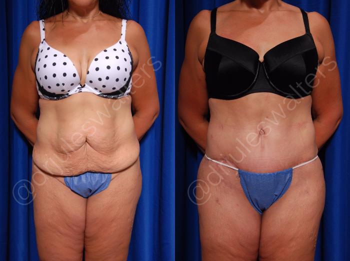 Before & After Body Contouring Case 19 View #1 View in Metairie and New Orleans, LA