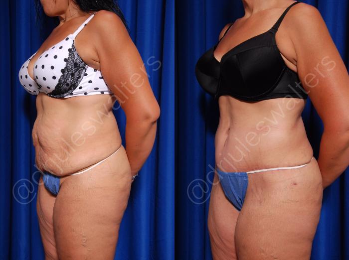 Before & After Body Contouring Case 19 View #2 View in Metairie and New Orleans, LA