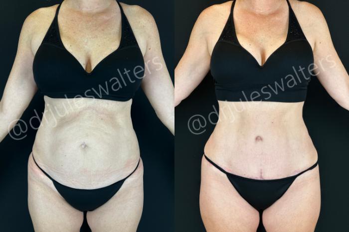 Before & After Tummy Tuck Case 199 Front View in Metairie and New Orleans, LA