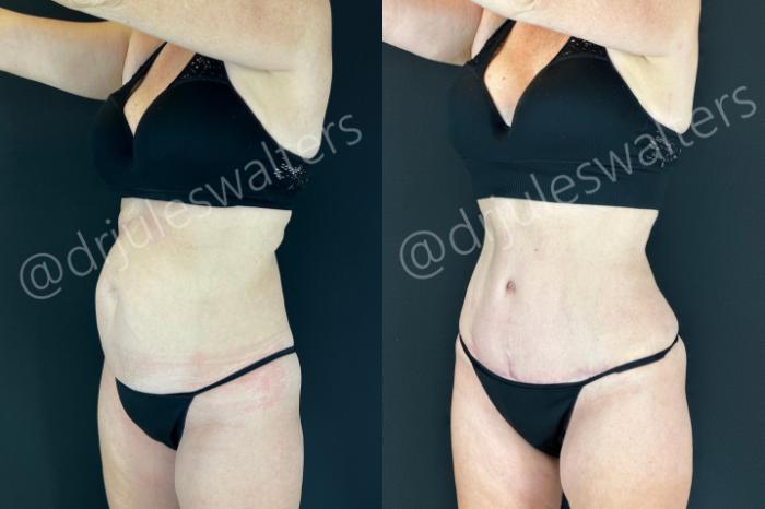 Before & After Tummy Tuck Case 199 Left Oblique View in Metairie and New Orleans, LA