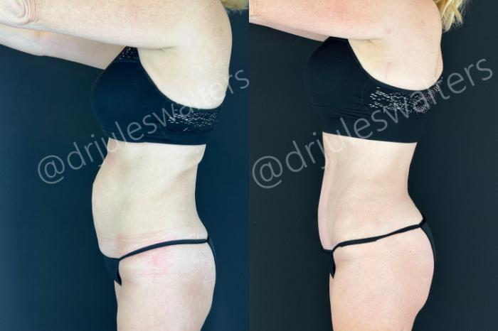 Before & After Tummy Tuck Case 199 Left Side View in Metairie and New Orleans, LA