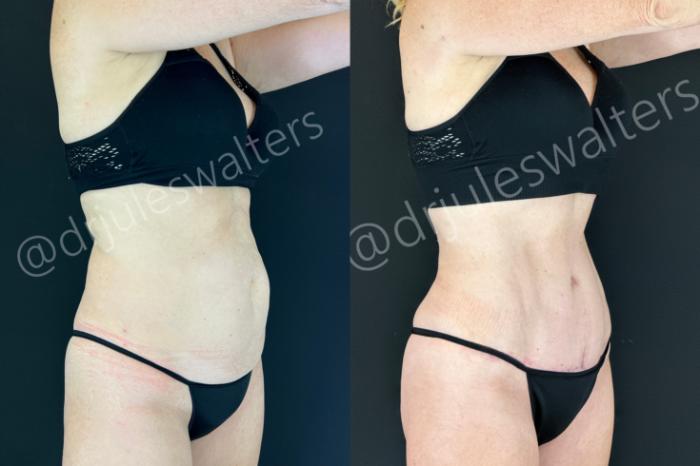 Before & After Tummy Tuck Case 199 Right Oblique View in Metairie and New Orleans, LA