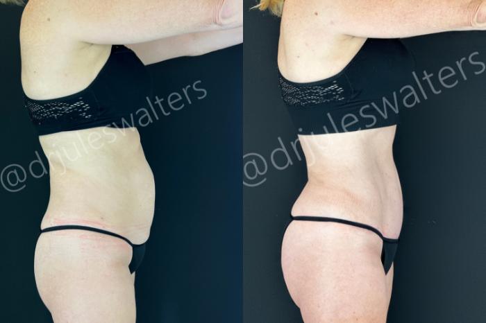 Before & After Tummy Tuck Case 199 Right Side View in Metairie and New Orleans, LA