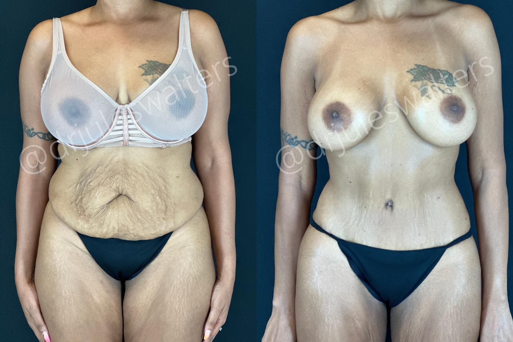 Before & After Tummy Tuck Case 206 Front View in Metairie and New Orleans, LA