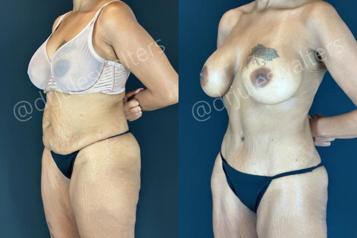 Before & After Tummy Tuck Case 206 Left Oblique View in Metairie and New Orleans, LA