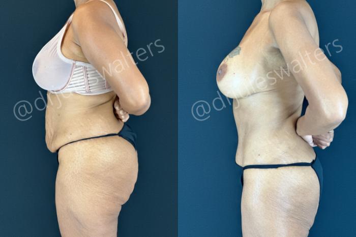 Before & After Tummy Tuck Case 206 Left Side View in Metairie and New Orleans, LA