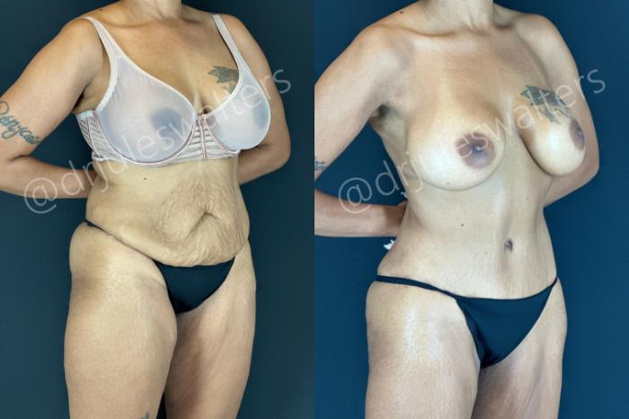 Before & After Tummy Tuck Case 206 Right Oblique View in Metairie and New Orleans, LA