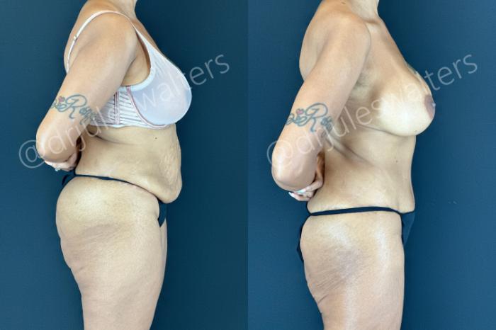 Before & After Tummy Tuck Case 206 Right Side View in Metairie and New Orleans, LA