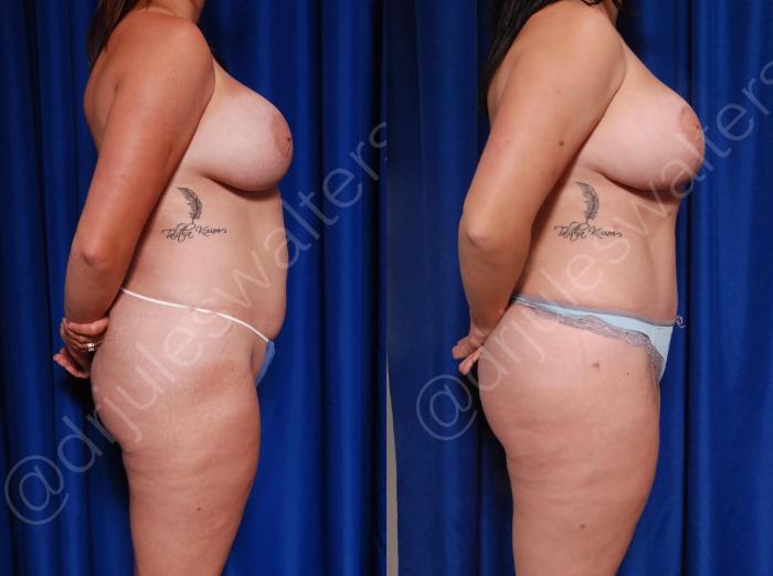 Before & After Tummy Tuck Case 4 View #1 View in Metairie and New Orleans, LA