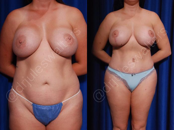 Before & After Breast Revision Case 4 View #2 View in Metairie and New Orleans, LA