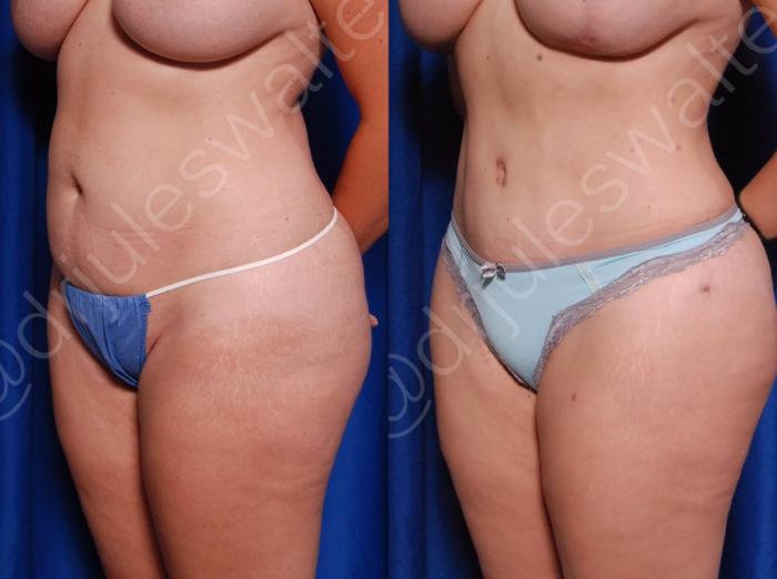 Before & After Breast Revision Case 4 View #4 View in Metairie and New Orleans, LA