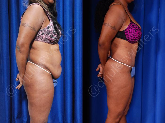Before & After Tummy Tuck Case 45 View #2 View in Metairie and New Orleans, LA