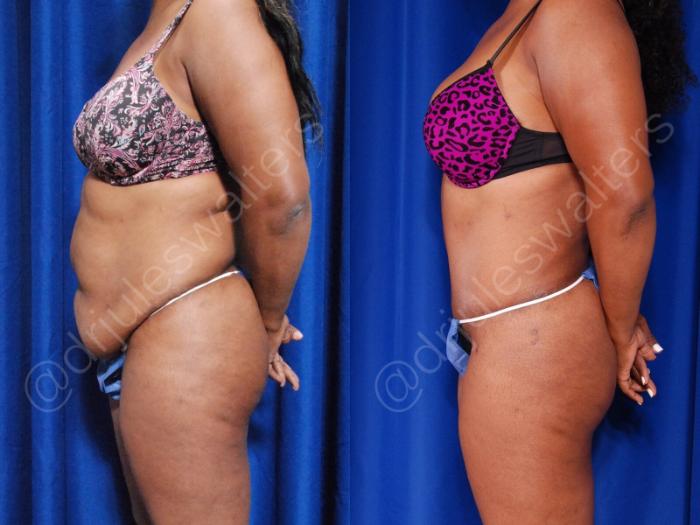Before & After Liposuction Case 45 View #3 View in Metairie and New Orleans, LA