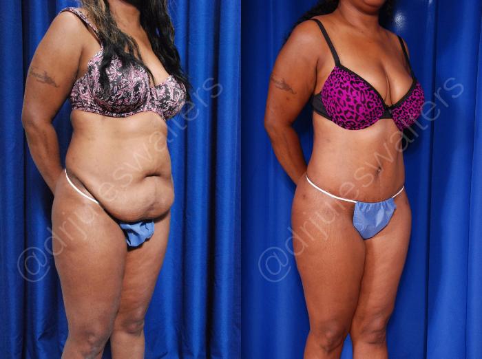 Before & After Tummy Tuck Case 45 View #4 View in Metairie and New Orleans, LA