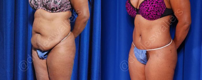 Before & After Liposuction Case 45 View #5 View in Metairie and New Orleans, LA