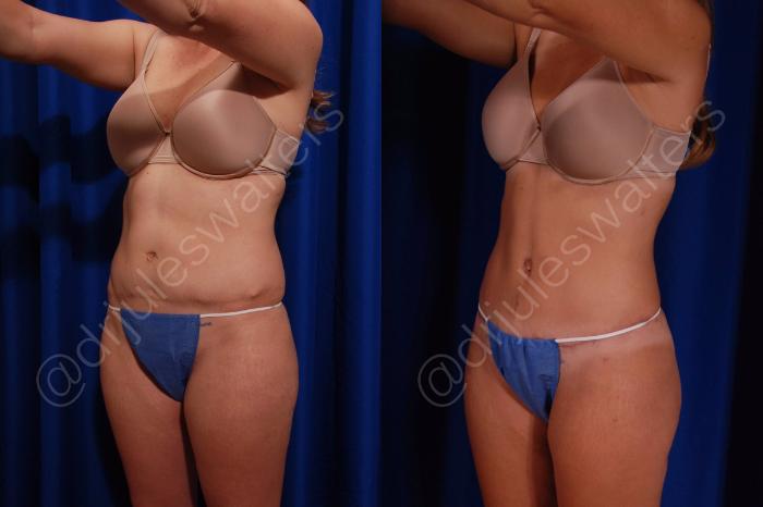 Before & After Tummy Tuck Case 54 View #1 View in Metairie and New Orleans, LA