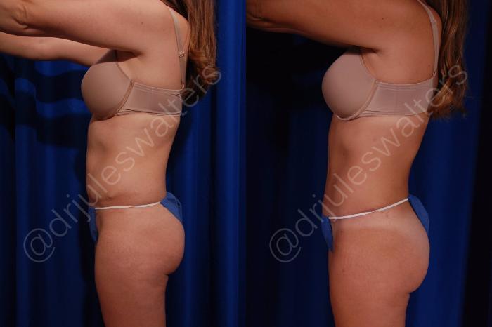 Before & After Liposuction Case 54 View #2 View in Metairie and New Orleans, LA