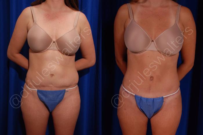 Before & After Liposuction Case 54 View #3 View in Metairie and New Orleans, LA