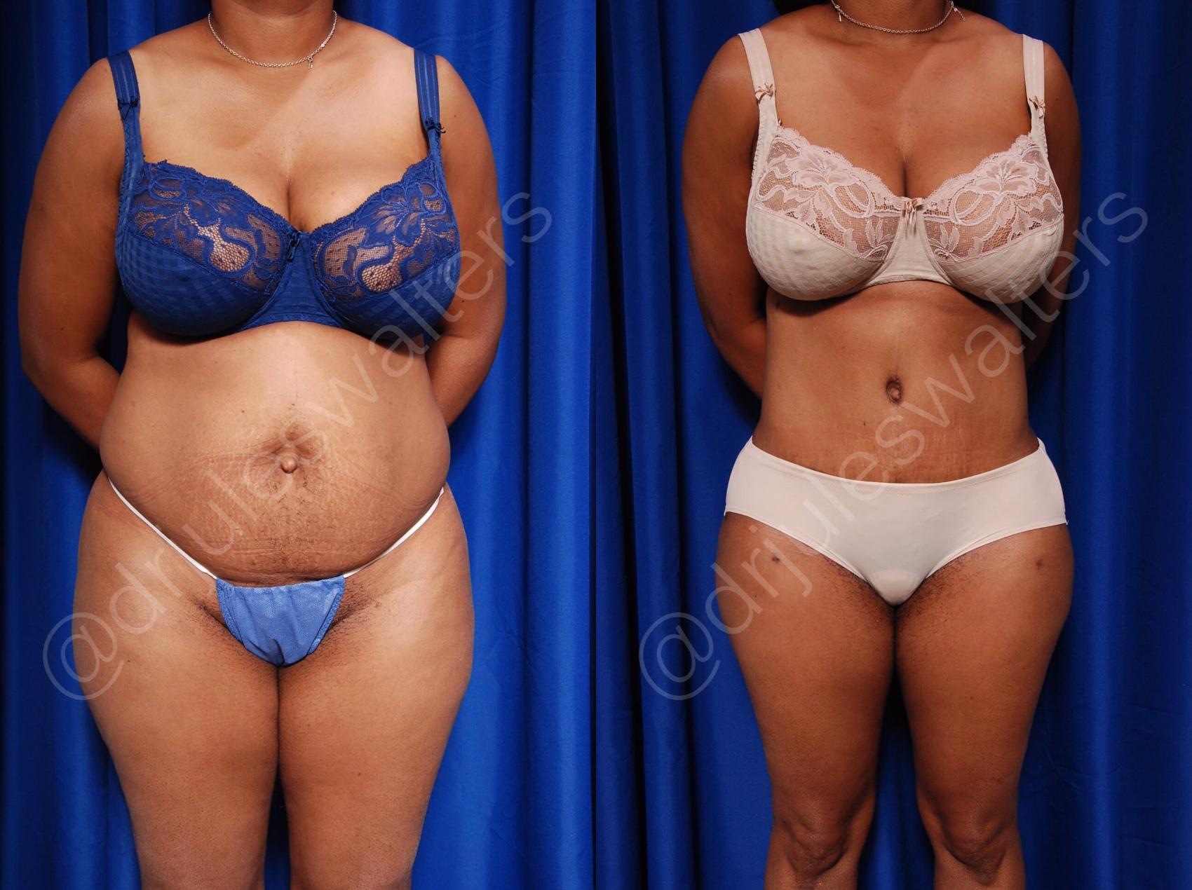 Before & After Tummy Tuck Case 55 View #1 View in Metairie, New Orleans, Covington, LA